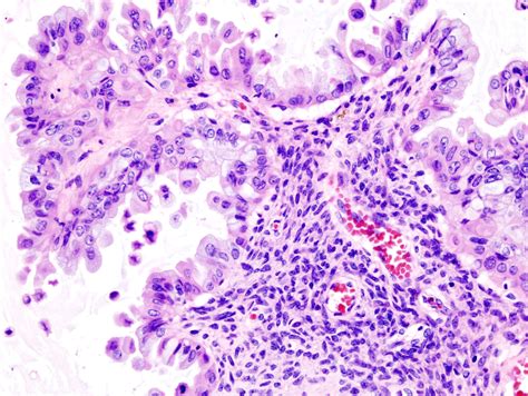 mucinous borderline tumor ovary